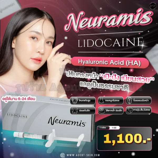 neuramis lidocaine